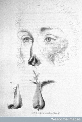Illustration of a face with a nose missing, and two noses below